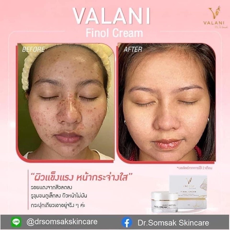 valani-finol-cream-ครีมหมอสมศักดิ์-dr-somsak-clinic-ครีมคลินิกหมอโดยตรง-ครีมที่หยุดเวลาให้ผิวคุณได้สวยที่สุด