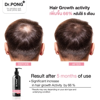 ภาพขนาดย่อของภาพหน้าปกสินค้าแชมพูลดผมร่วง Dr.PONG TSUTSUJI GENTLE SHAMPOO แชมพูลดผมร่วง เพิ่มวอลุ่ม anti-hairloss shampoo จากร้าน drpongshop บน Shopee ภาพที่ 7