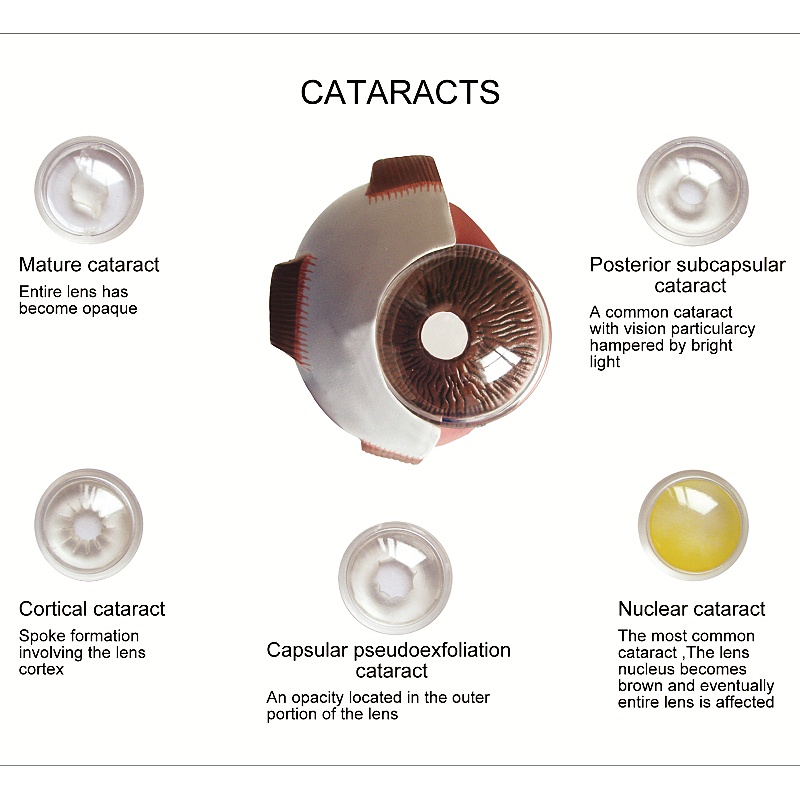 cornea-โมเดลลูกตามนุษย์-พร็อพการสอนกายวิภาคศาสตร์