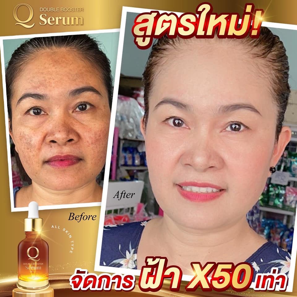 สูตรใหม่เข้มข้น-เซรั่มคิว-คิวดับเบิ้ลบูสเตอร์เซรั่ม-เซรั่มฝ้า-เซรั่มหน้าเด็ก-เซรั่มหน้าใส