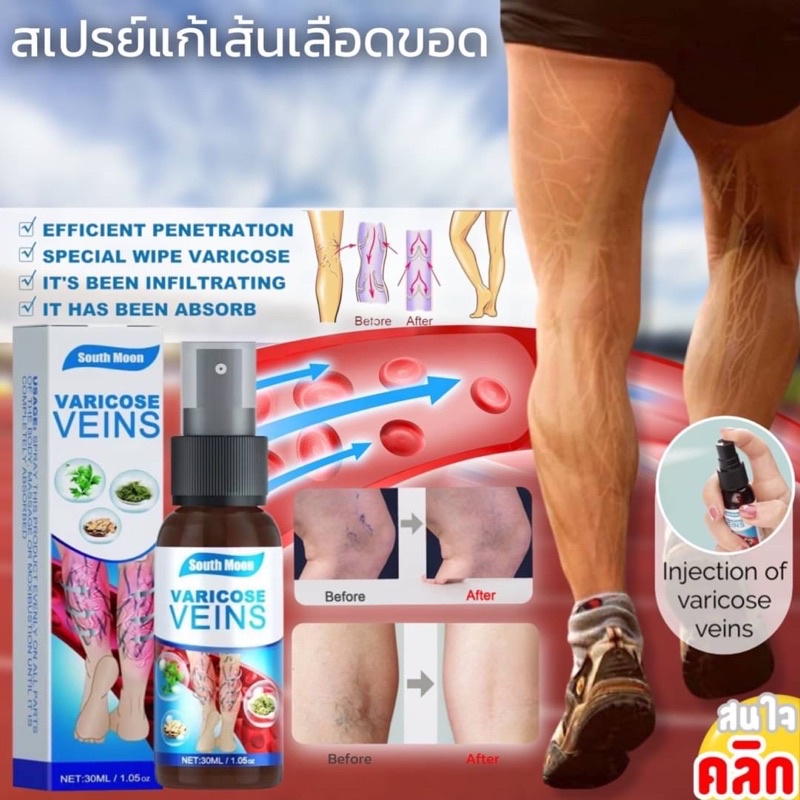 varicose-veins-spray-สเปรย์รักษาเส้นเลือดขอด