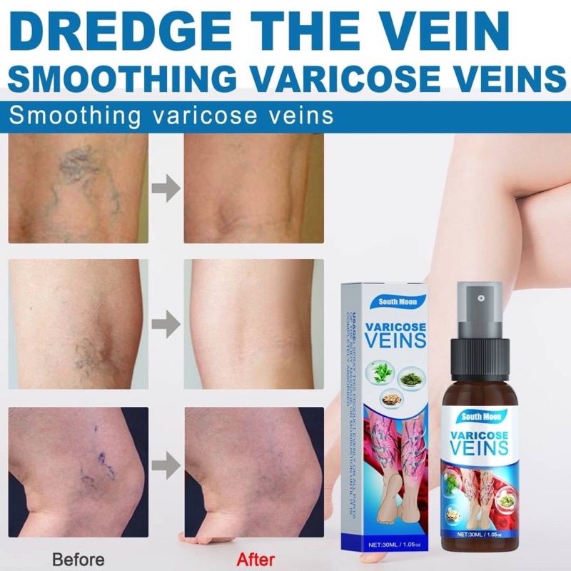 varicose-veins-spray-สเปรย์รักษาเส้นเลือดขอด