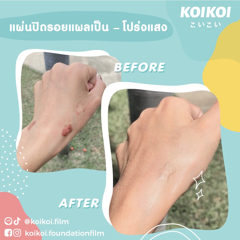 koikoi-foundation-film-scar-แผ่นฟิล์มสำหรับปกปิดรอยแผลเป็น-พรางรอยแผลเป็นได้เนียนกริบ