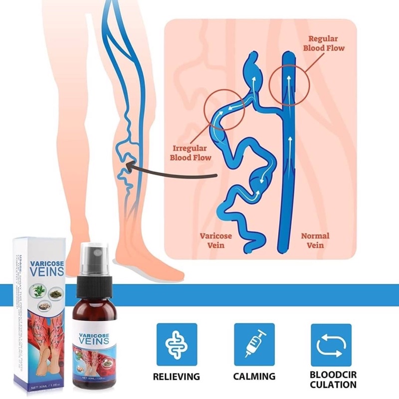 varicose-veins-spray-สเปรย์รักษาเส้นเลือดขอด