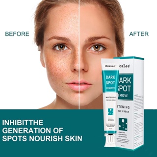 iBeaLee Whitening Freckle Cream Remove Melasma Cream Remove Freckles Remove Dark Spots Melasma Remover Brighten Skin Anti-Aging 20ml