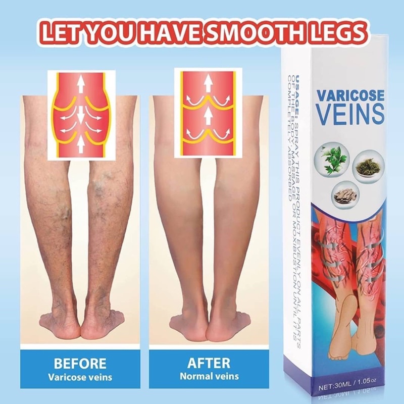 varicose-veins-spray-สเปรย์รักษาเส้นเลือดขอด