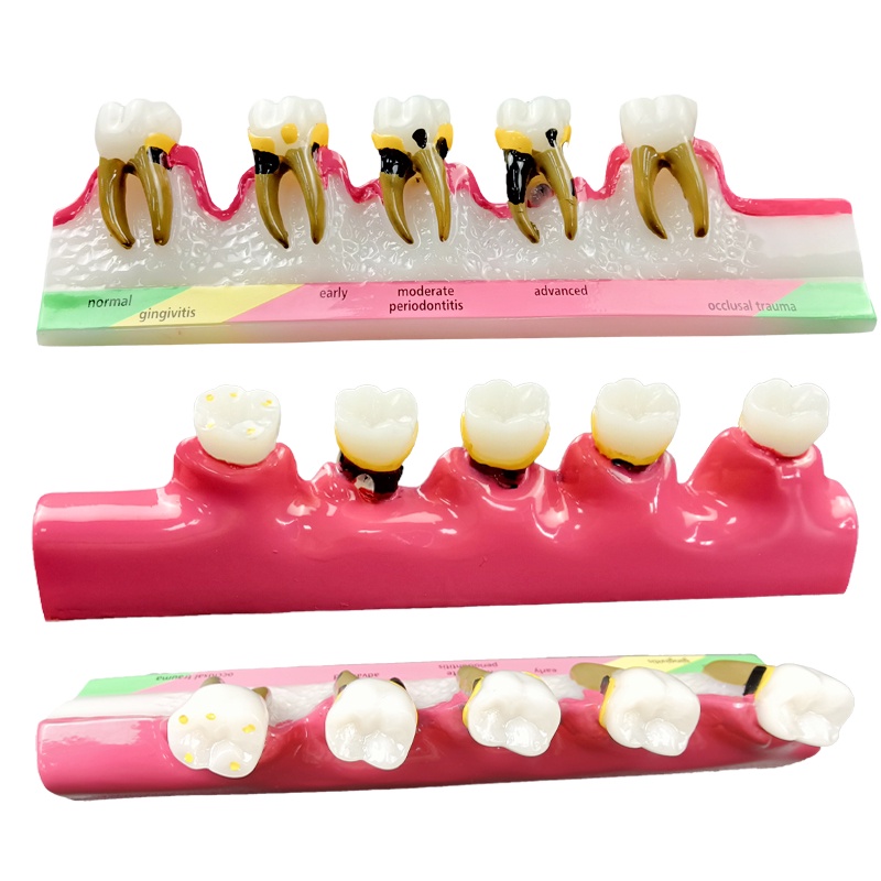 ddydental-caries-evolution-5-stage-demo-สําหรับโมเดลทันตกรรม