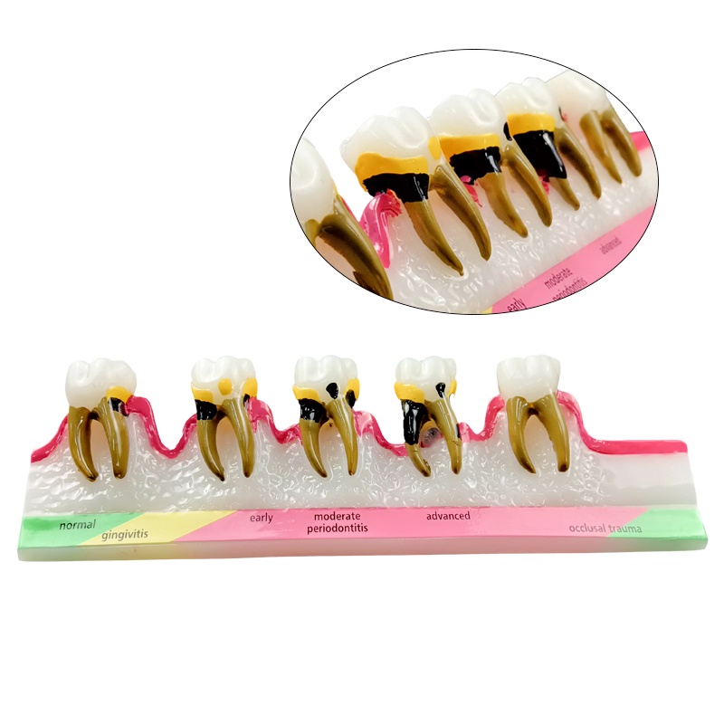 ddydental-caries-evolution-5-stage-demo-สําหรับโมเดลทันตกรรม