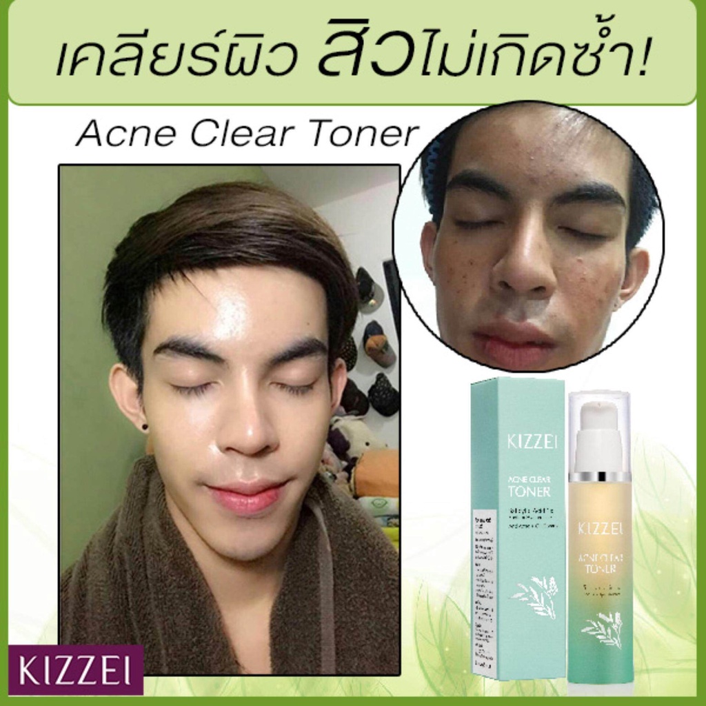kizzei-acne-clear-toner-50ml-โทนเนอร์-เพื่อ-สิวอุดตัน-สิวอักเสบ-ผิวแพ้ง่าย-โทนเนอร์สิว-รูขุมขนกว้าง-ลดหน้ามัน-สิวเสี้ยน