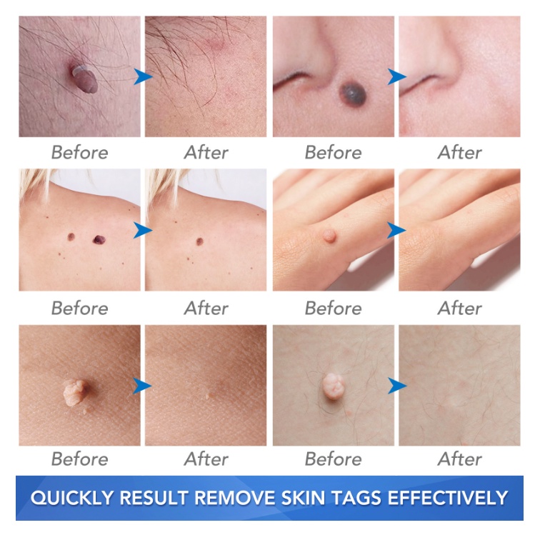 อุปกรณ์กําจัดหูด-skin-tag-removal-kit-skin-tag