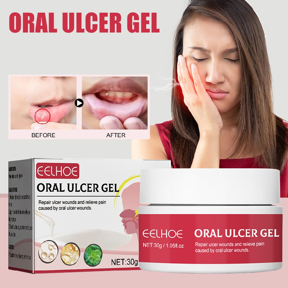 Oral Ulcer Gel Effectively Relieve Oral Wound Pain Denture Pain Relief