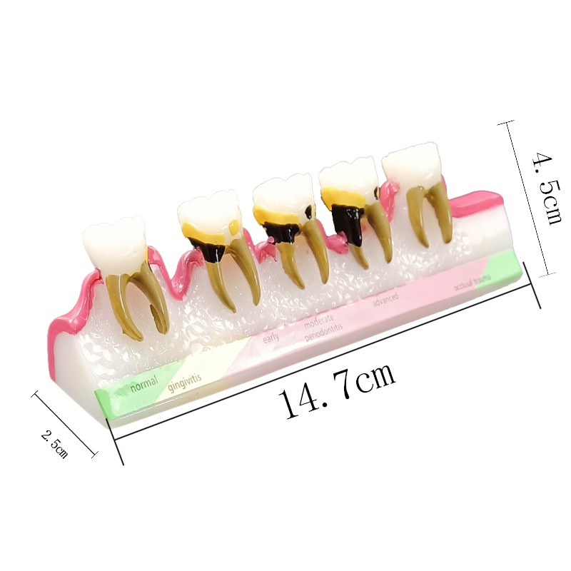 ddydental-caries-evolution-5-stage-demo-สําหรับโมเดลทันตกรรม