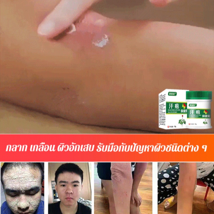 รักษาให้หายขาด-ยาทารักษากลาก-เกลื้อน-ลดอาการผิวอักเสบ