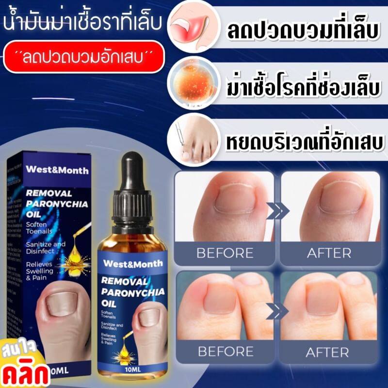 blueoutlet-removal-paronychia-oil-น้ำมันฆ่าเชื้อราที่เล็บลดปวดบวมอักเสบ