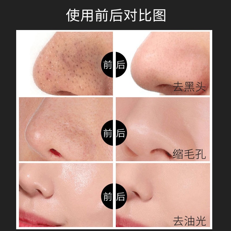 hot-sale-kniyea-blackhead-removal-nasal-mask-blackhead-removal-nasal-sticker-closed-acne-cleaning-mask-pore-removal-8cc