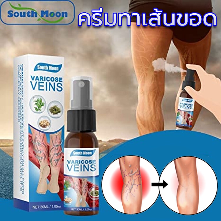 south-moon-เส้นเลือดขอด-30ml-ครีมทาเส้นขอด-สเปรย์-บอกลาเส้นเลือดขอดเส้นเลือดดำอุดตันและอาการปวด-ครีมทาเส้นเลือดขอด