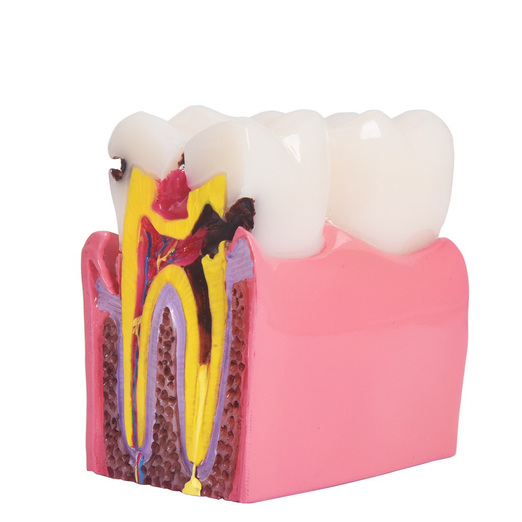 เครื่องมือทันตกรรม-decay-ฟันเปรียบเทียบโมเดลการศึกษา-6-เท่า-caries-เครื่องมือการสอนฟัน
