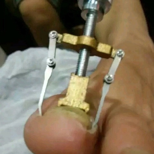 abongsea-เครื่องมือแก้ไขเล็บคุดนิ้วเท้า-แบบมืออาชีพ