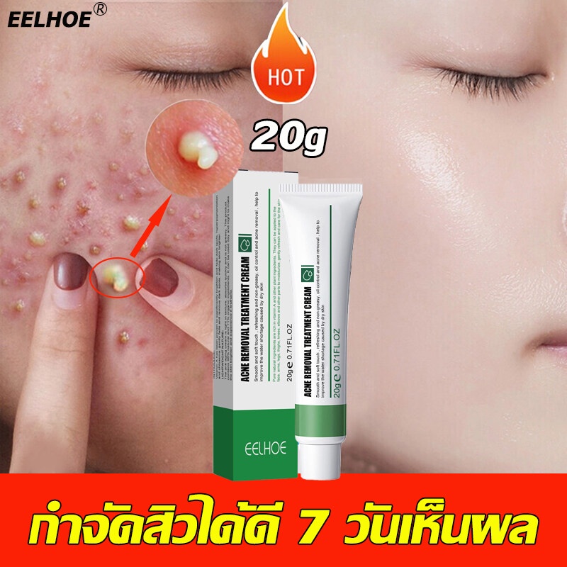 กำจัดสิว-20ml-ลดสิวเสี้ยนครีมรักษาสิว-สลายสิวอุดตันที่ต้นตอ-อ่อนโยนและไม่ระคาย-ครีมลดสิว-ครีมกำจัดสิว-เจลแต้มสิว