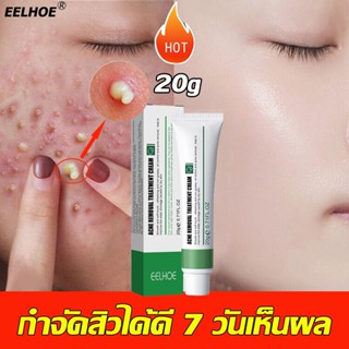 กำจัดสิว 20ML ลดสิวเสี้ยนครีมรักษาสิว สลายสิวอุดตันที่ต้นตอ อ่อนโยนและไม่ระคาย ครีมลดสิว ครีมกำจัดสิว เจลแต้มสิว