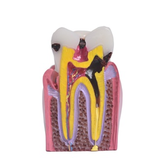 เครื่องมือทันตกรรม Decay ฟันเปรียบเทียบโมเดลการศึกษา 6 เท่า Caries เครื่องมือการสอนฟัน