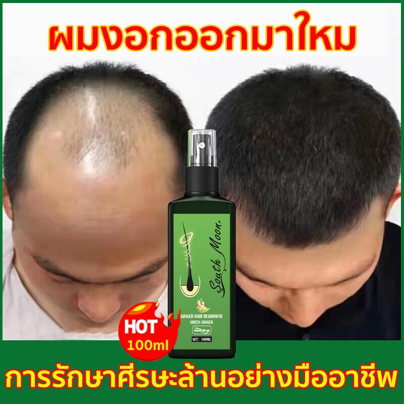 บอกลาหัวล้าน-ปลูกผมหนา-ช่วยลดผมร่วง-สเปรย์ปลูกผม-ยาปลูกผม-ป้องกันผมร่วงน้ำยาเร่งผมยาว-น้ำยาปลูกผม