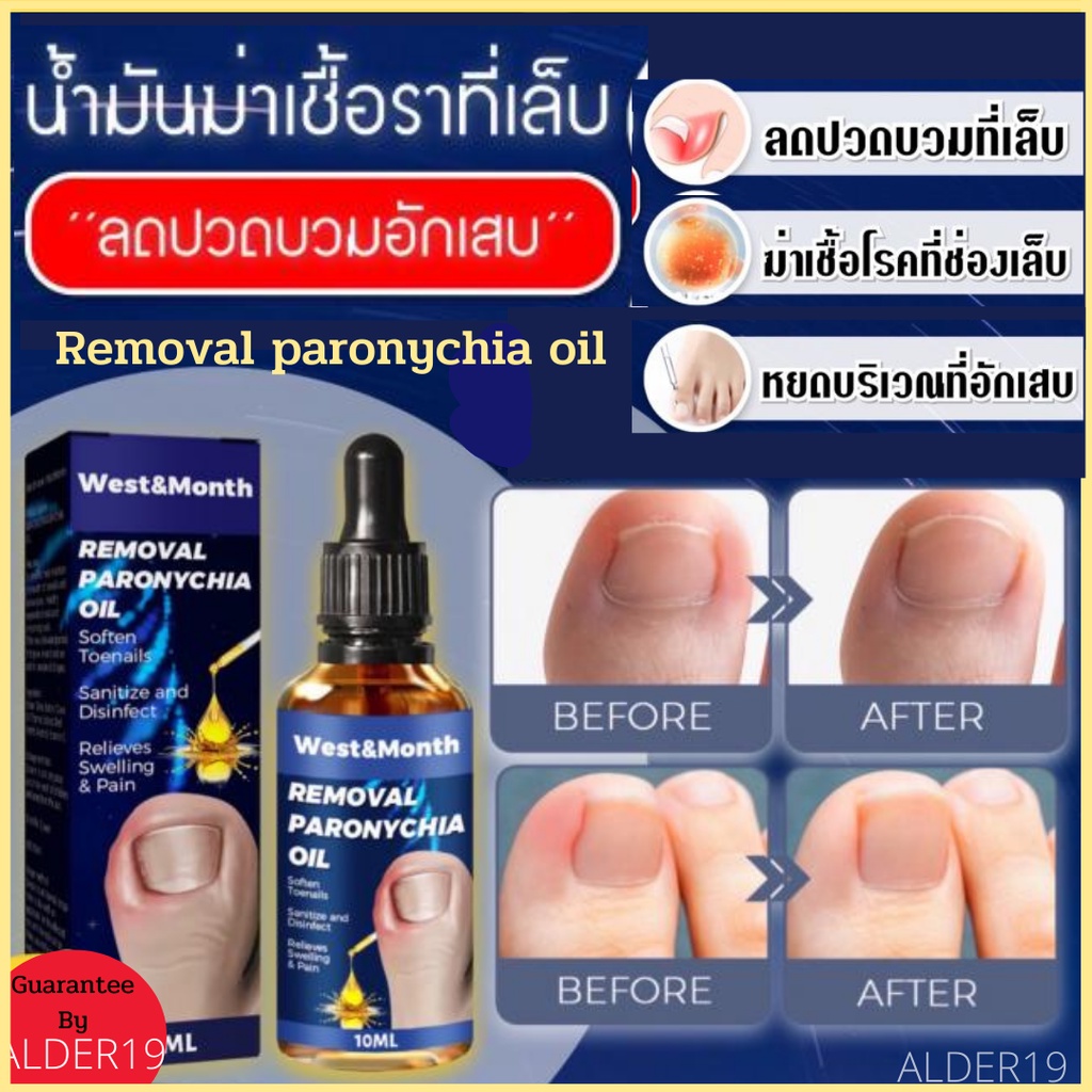 น้ำมันลดเชื้อราเล็บ-removal-paronychia-oil-น้ำมันฆ่าเชื้อราที่เล็บลดปวดบวมอักเสบ-ลดปวดบวม-เล็บอักเสบ-บำรุงเล็บ