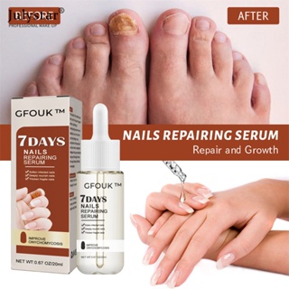 JULYSTAR Cfouk 7 Days Nail Repair Essence ฟื้นฟูมือและเท้า Onychomycosis Rotten Toenail Soft Nail Thickening Moisturizing Care Essence