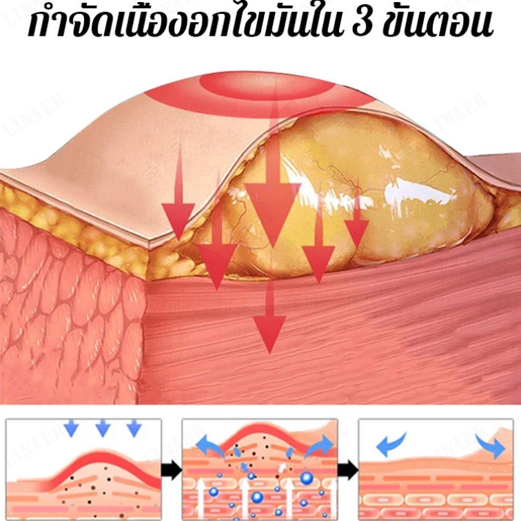 ขจัดก้อนเนื้อ-ชาสมุนไพรขจัดก้อนไขมัน์และล้างปอด