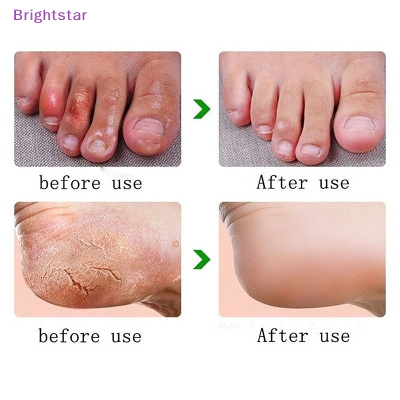 brightstar-ครีมบํารุงผิวเท้า-ป้องกันส้นเท้าแตก-33-กรัม