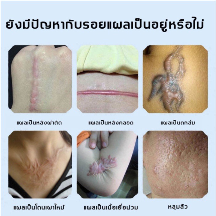 100-u-s-a-เดอร์มาติกซ์-ครีมลบแผลเป็น-เจลลดรอยแผลเป็น-ซ่อมแซมผิวที่เสียหาย-บำรุงผิวให้แข็งแรง-15g-dermatix-ultra-gel