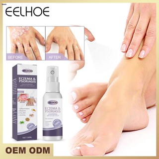 Tinea Pedis สเปรย์ ยารักษาโรคกลาก 30mlหนังศีรษะ โรคสะเก็ดเงิน มือ เท้า กลิ่นเกลื้อน ยับยั้งเชื้อรา ป้องกันอาการคัน
 【doom】