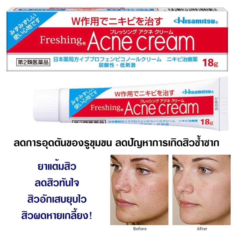 Hisamitsu Freshing Acne Cream 18g. ย-าดแต้มสิว ลดสิวทันใจ สิวอักเสบยุบ ...