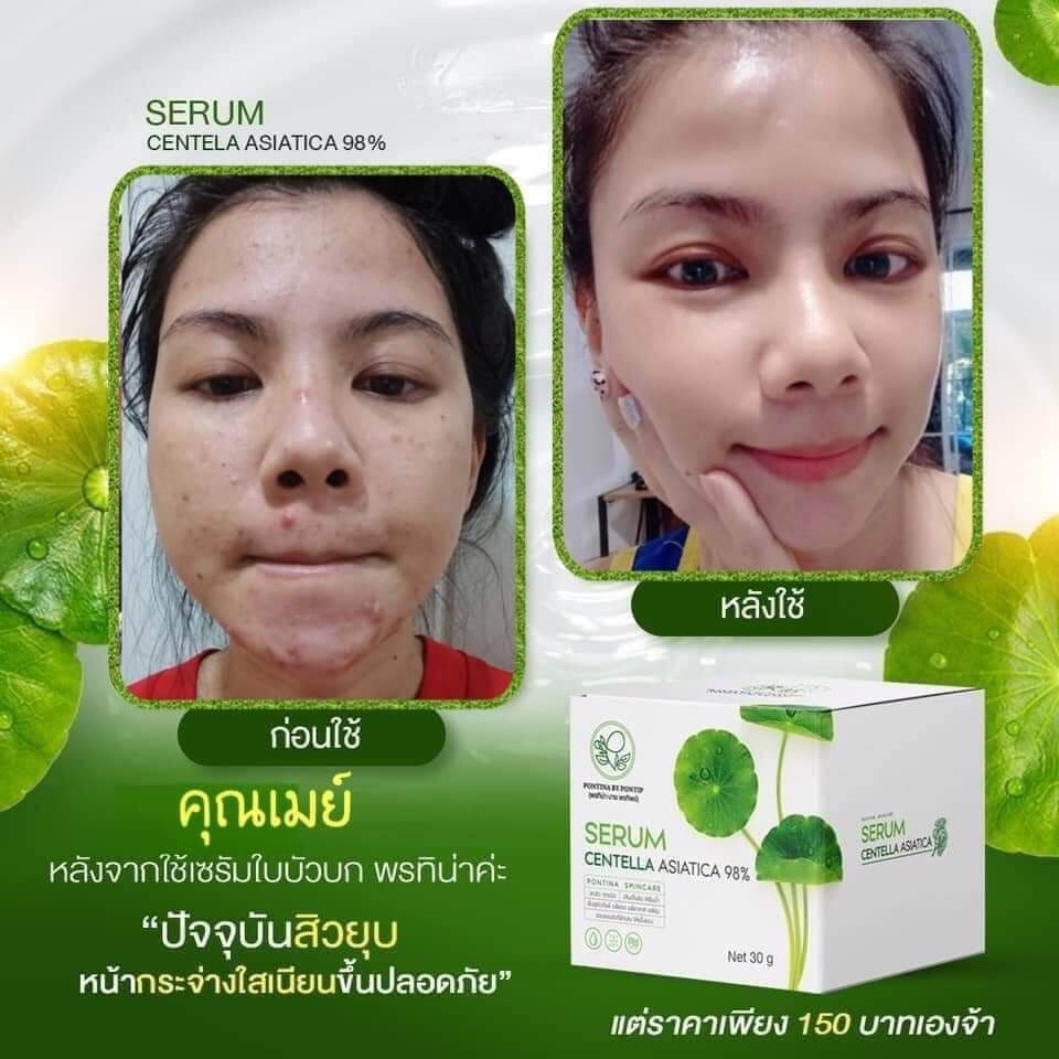 เซรั่มใบบัวบก-พรทิน่า-ว่านหางจระเข้-pontina-skincare-ฟื้นฟูผิวแพ้ครีม-ผิวไหม้แดด-สิว