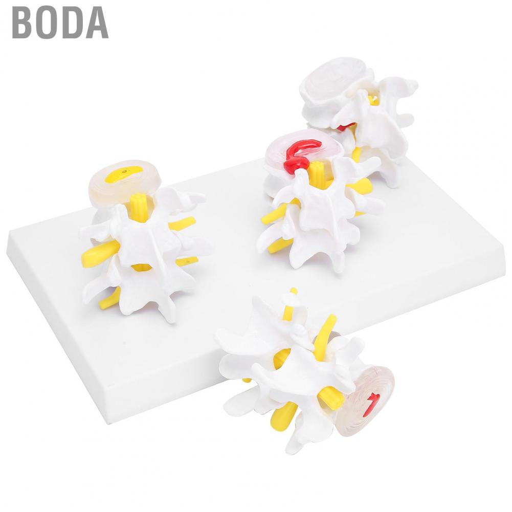 boda-spine-model-normal-pathological-spine-model-human-spine-model-four-stage-vertebrae-conditions-pathological-spine-model-for-doctors-office-educational-tool