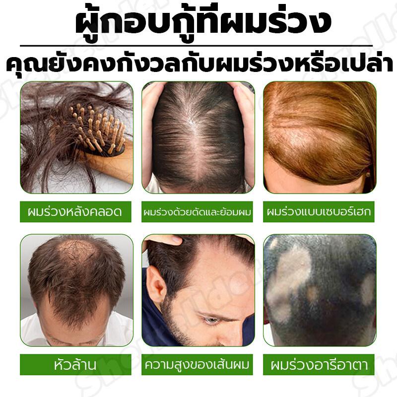 บอกลาหัวล้าน-ปลูกผมหนา-ช่วยลดผมร่วง-สเปรย์ปลูกผม-ยาปลูกผม-ป้องกันผมร่วงน้ำยาเร่งผมยาว-น้ำยาปลูกผม