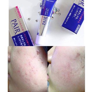 pair-acne-cream-w-แพ-ครีมแต้มสิวจากญี่ปุ่น-ช่วยให้สิวยุบเร็ว-ลดอาการสิวบวมแดง-ได้เป็นอย่างดี