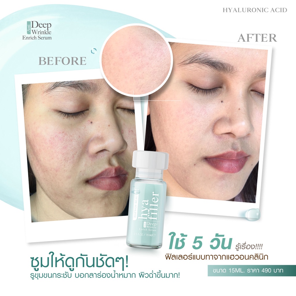 ทดลองใช้-haewon-hyaluron-filler-ฟิลเลอร์แบบทา-ขนาดทดลอง-6ml-เซรั่มไฮยา-ฟื้นฟูผิว-ลดริ้วรอย-กระชับ-เต่งตึง