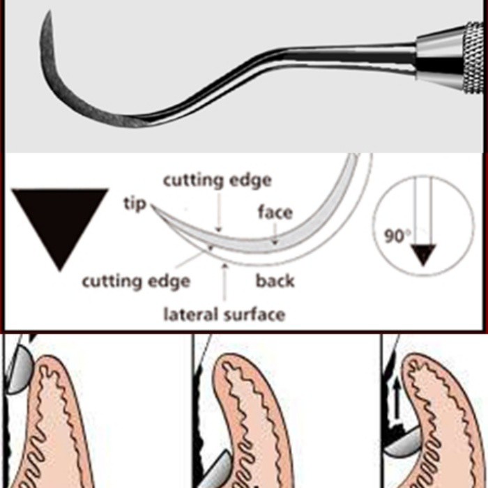 trim-ที่ขูดหินปูน-ราคาประหยัด-ที่ขูดหินปูนด้วยตัวเอง-เครื่องมือขูดหินปูนด้ามจับอย่างดี