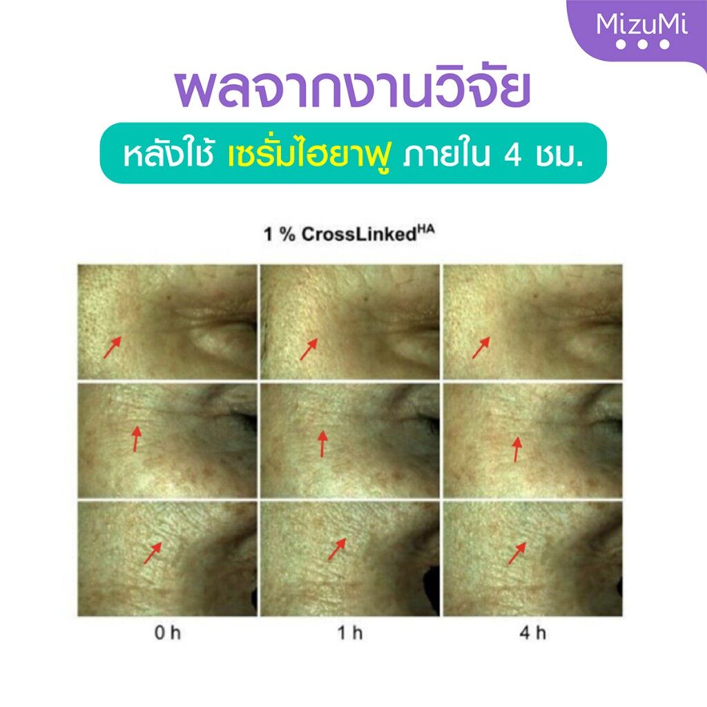 mizumi-hya-acne-repair-serum-เซรั่มไฮยาเกรดฟิลเลอร์-ฟื้นบำรุงผิวให้ดูฟูละเอียด-อิ่มน้ำ-6g-ต่อซอง