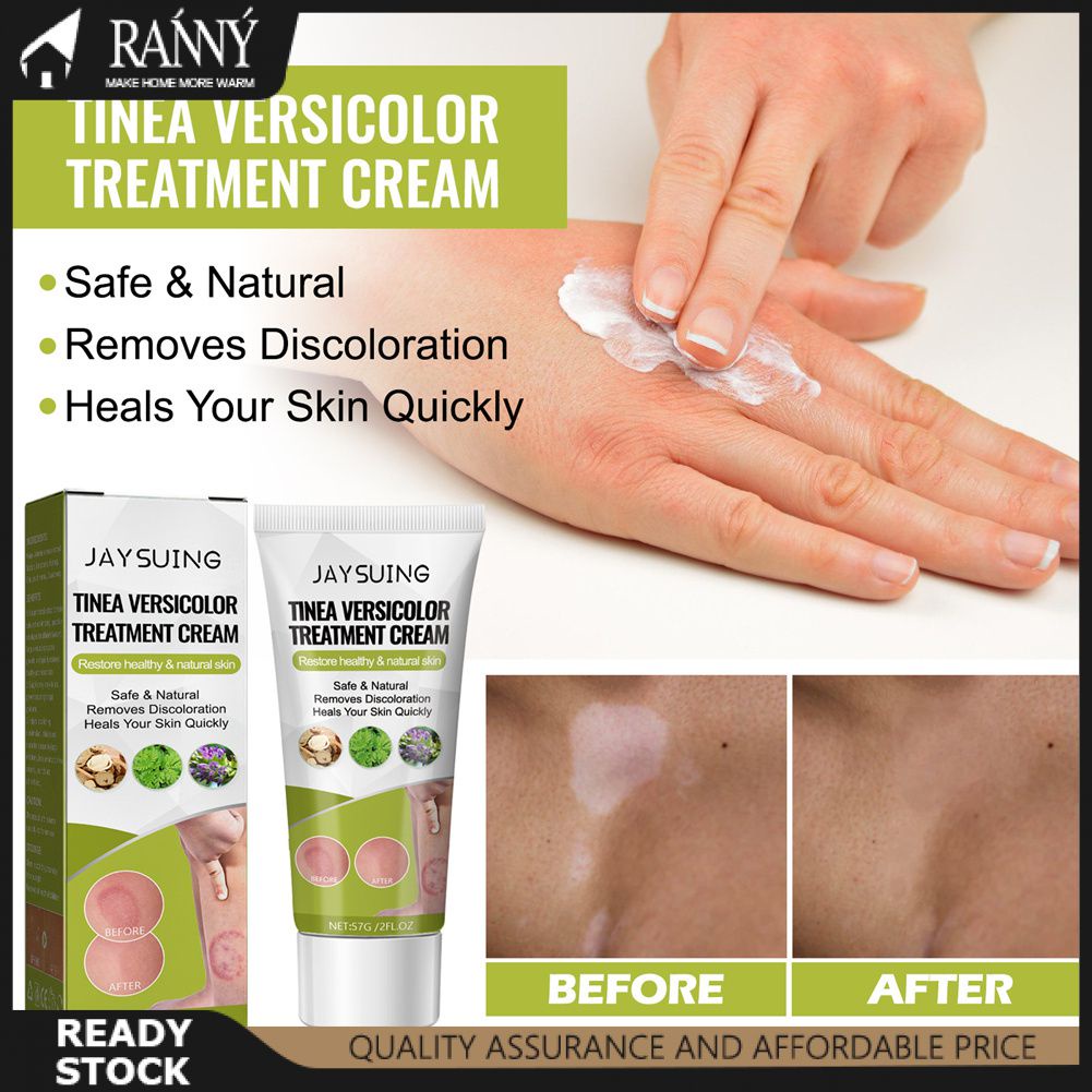 【Fast】 Jaysuing Tinea Versicolor Repair Cream Reduce Redness Swelling