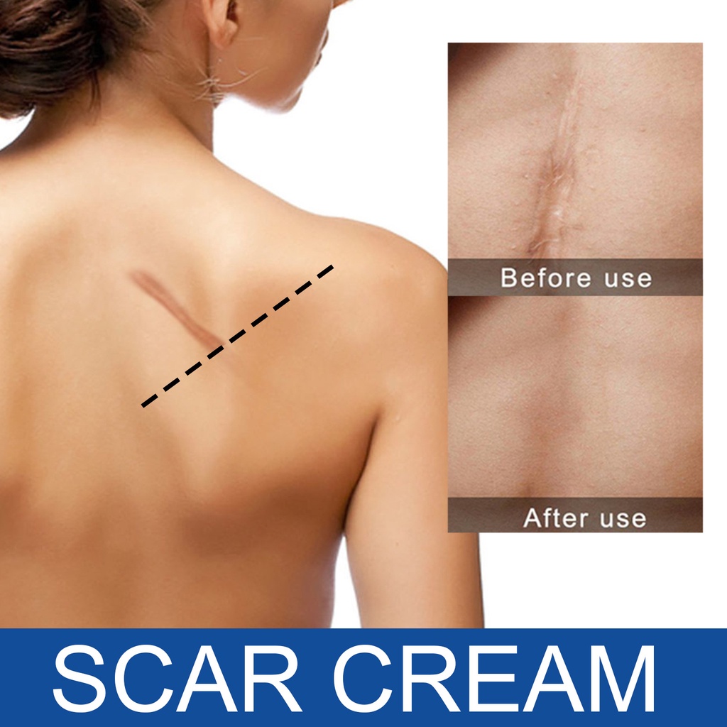 hot-sale-eelhoe-fade-scar-repair-cream-acne-marks-surgery-scar-smooth-skin-care-cream-skin-repair-cream-7-16li