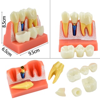 โมเดลฟันมงกุฎ ถอดออกได้ สําหรับการเรียนการสอน และสาธิต