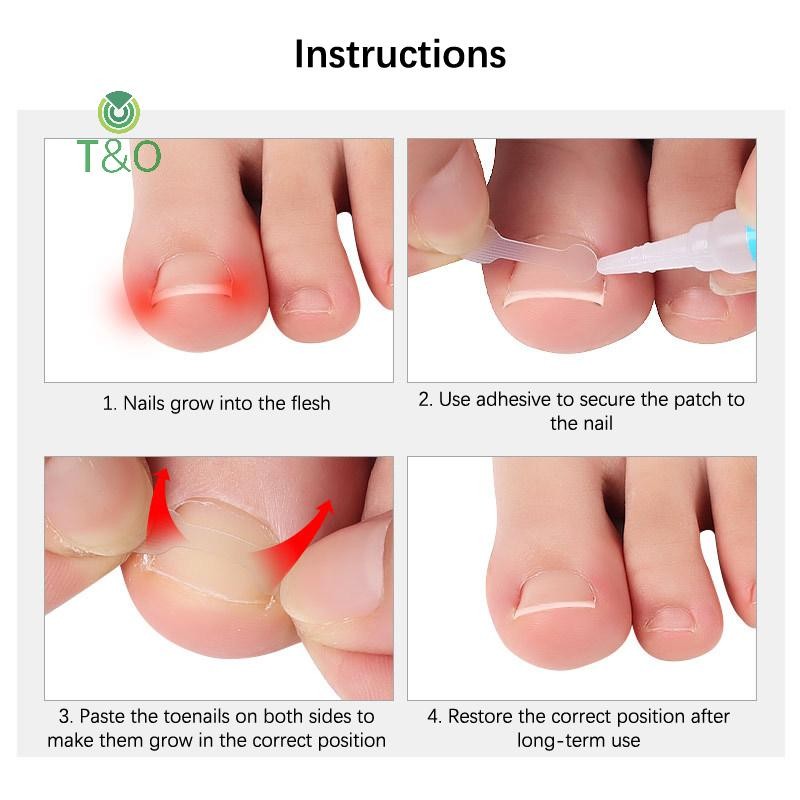 T&O 10 ชิ้นคุด Toenail Corrector เครื่องมือ Pedicure Recovered Toe Nail ...