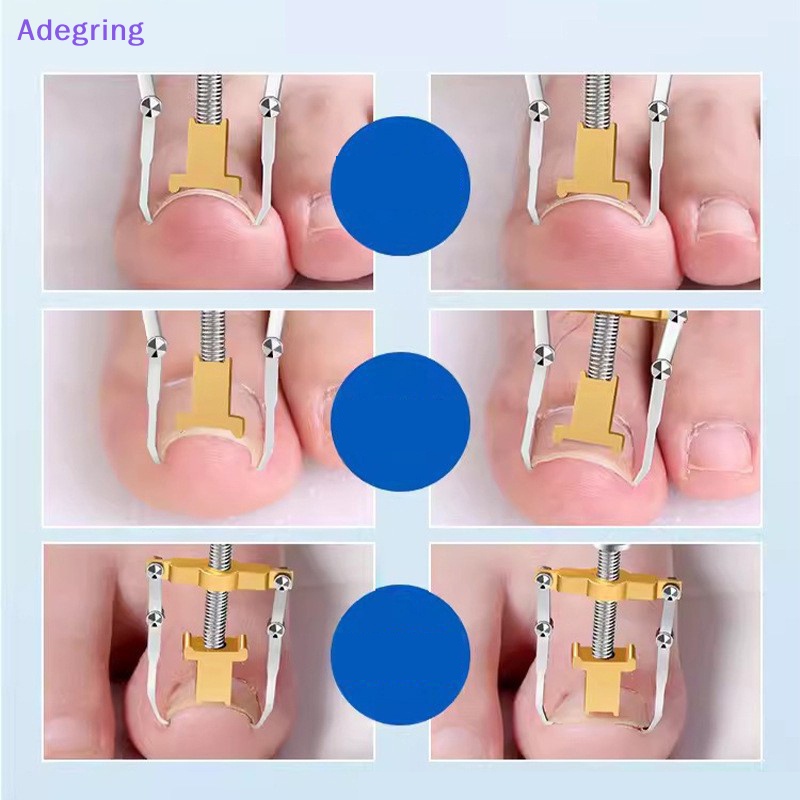 adegring-อุปกรณ์ดูแลเล็บคุดนิ้วเท้า-แก้ไขเล็บคุด