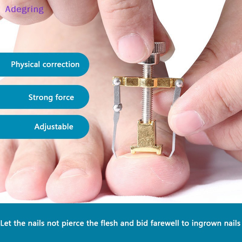 adegring-อุปกรณ์ดูแลเล็บคุดนิ้วเท้า-แก้ไขเล็บคุด