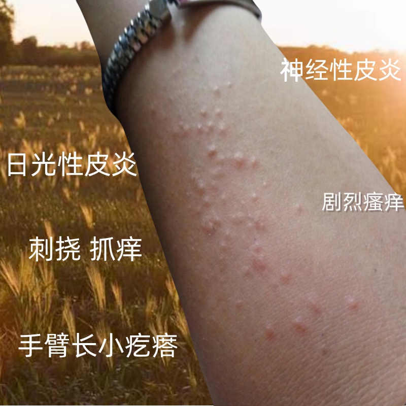 Dongfang Youpin small pimples on arms solar dermatitis severe pruritus skin summer dermatitis