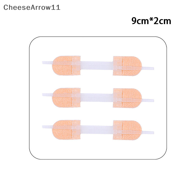 Che Zipper Tie Wound Closure Patch Hemostatic Patch Wound Fast Suture ...