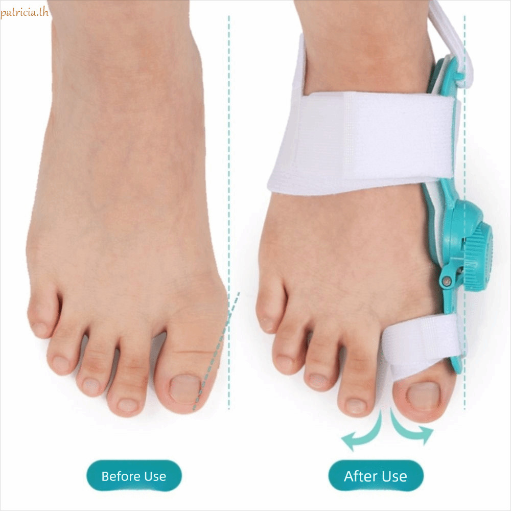 PATRIA Bunion Corrector, ปรับ Toe Valgus Big Toe Straightener, Toe Fix ...