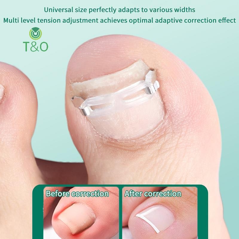 T&O 1 ชุดคุด Toenail Corrector เครื่องมือ Pedicure Recovered Toenail ...